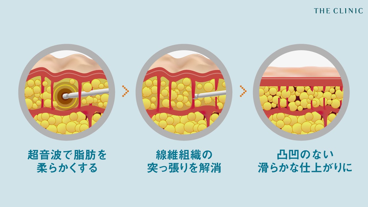 ベイザースムース セルライト除去 The Clinic 公式