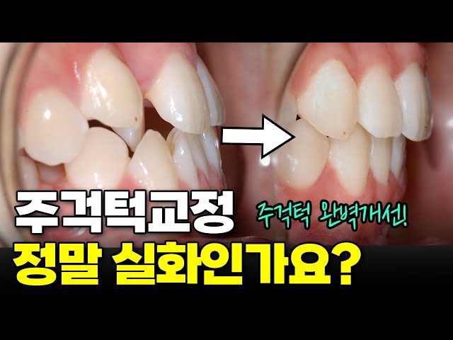 주걱턱 없애는 가장 확실한 방법!