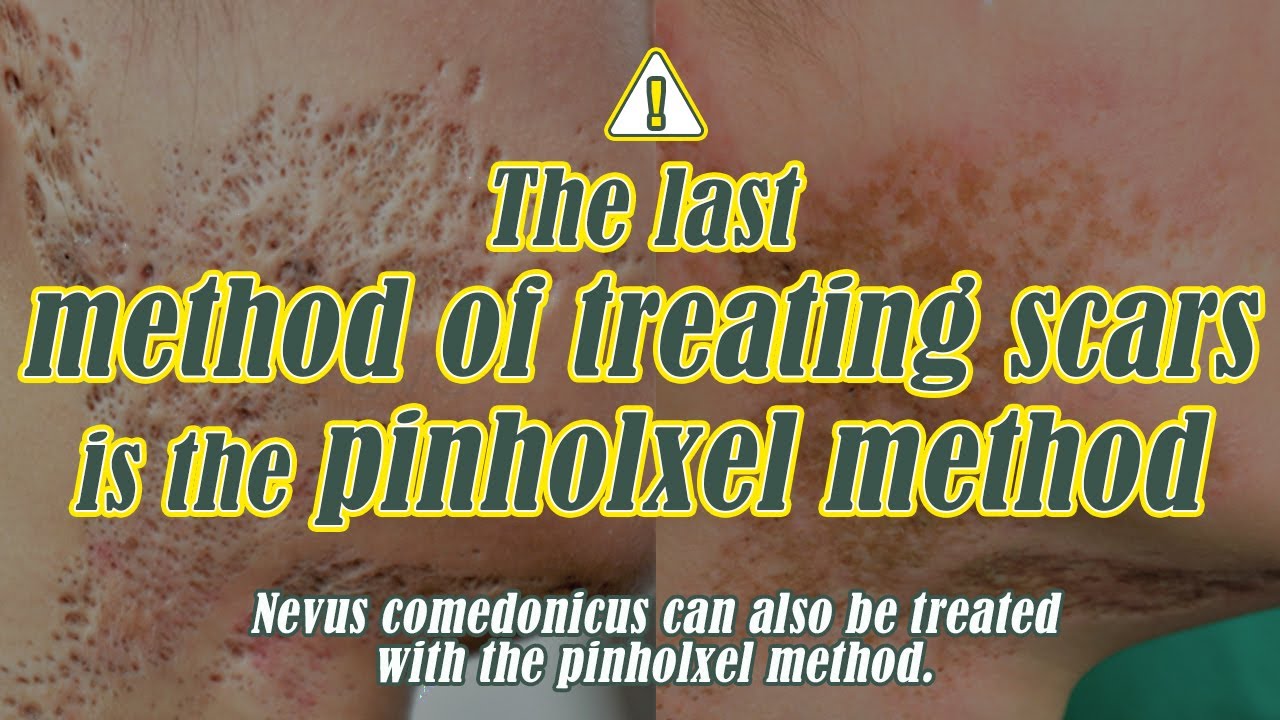 [Scar clinic in korea]Nevus comedonicus removal treatment with