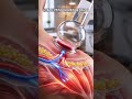 #cuppingtherapy #cupping