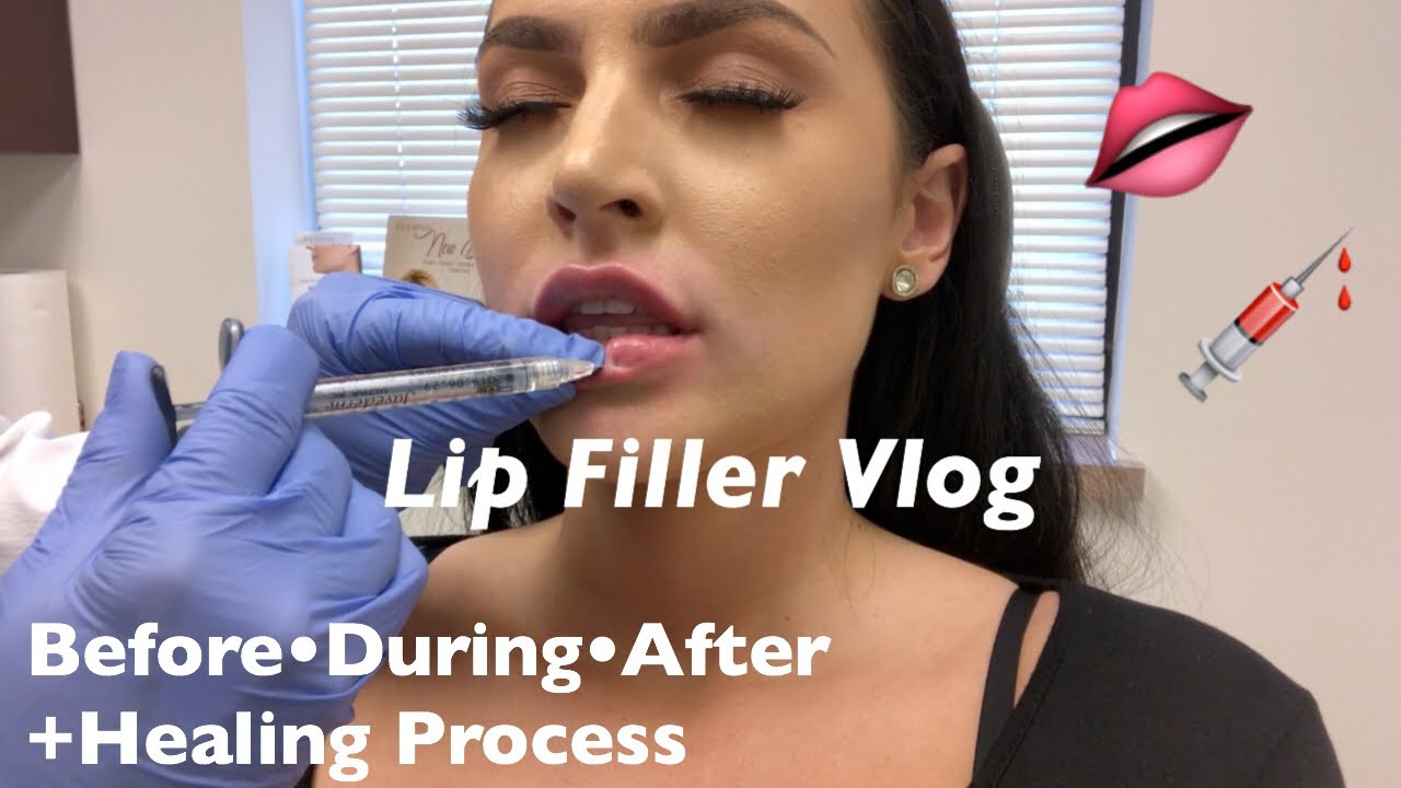 Lip Filler Vlog: My First Time Getting Lip Filler | Juvederm Ultra