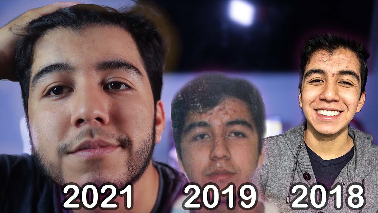 MI EXPERIENCIA CON ACNE SEVERO ( experiencia, tratamiento y consejos) 🥺