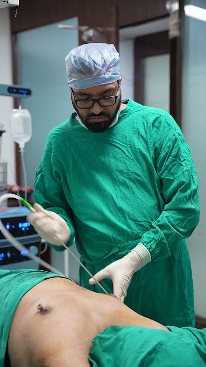Gynecomastia Surgery cost #shortvideo #shots #dezireclinicindia