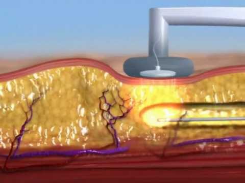 BodyTite RFAL with Animation & Before and After BodyTite RFAL with Animation & Before and After