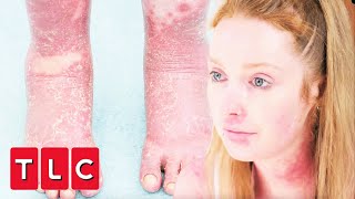 Woman Is Covered In Painful Psoriasis From Head To Toe! | Bad Skin Clinic
