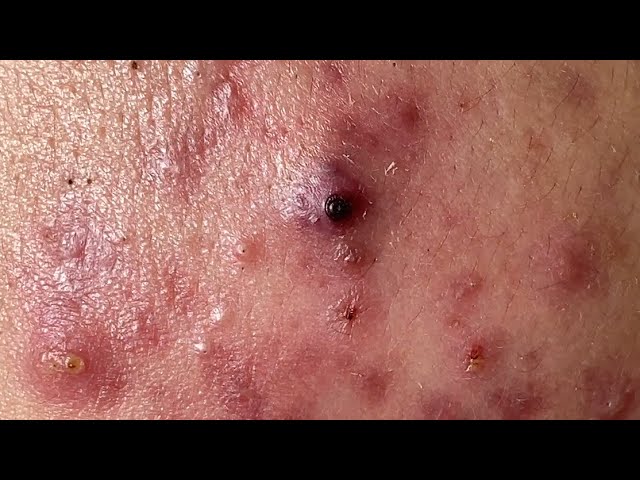 Acne Treatment Huong Da Nang#560  | 2023 | Hidden acne