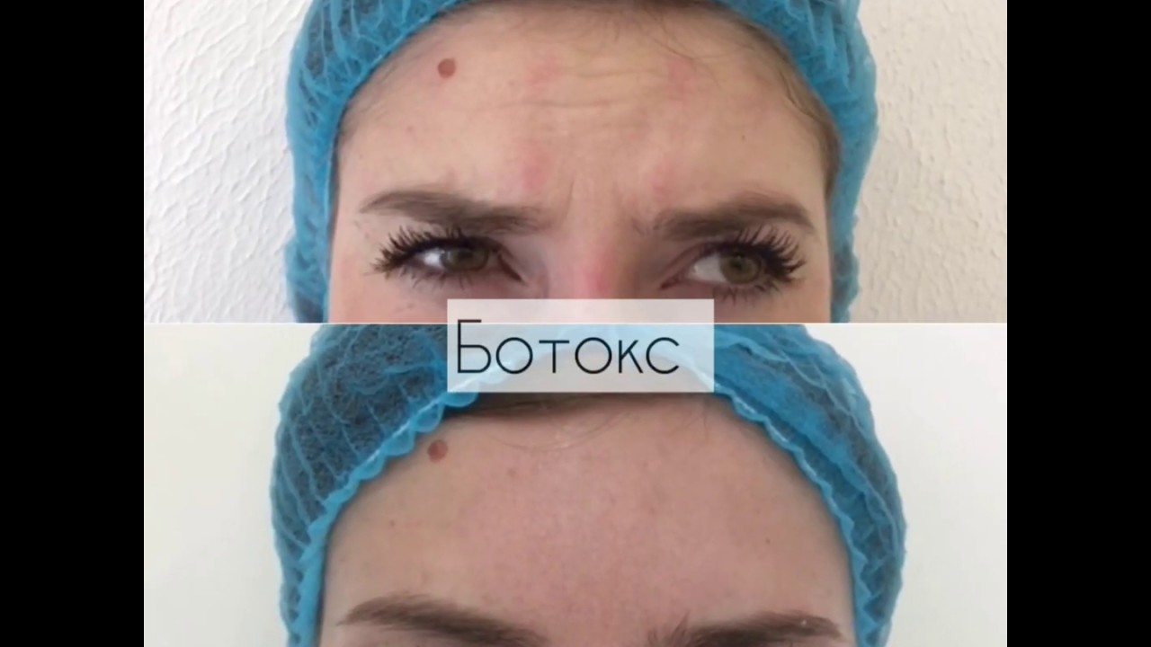 Коррекция морщин ботоксом - Косметолог Dr.Aina в Москве