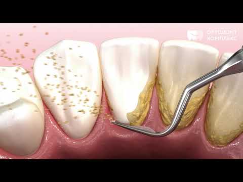 Видео: Профессиональная чистка зубов
