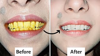Teeth Whitening at Home|FAST| 100% EFFECTIVE|Yellow Teeth NATURAL remedy| Hindi|Men&amp; Women