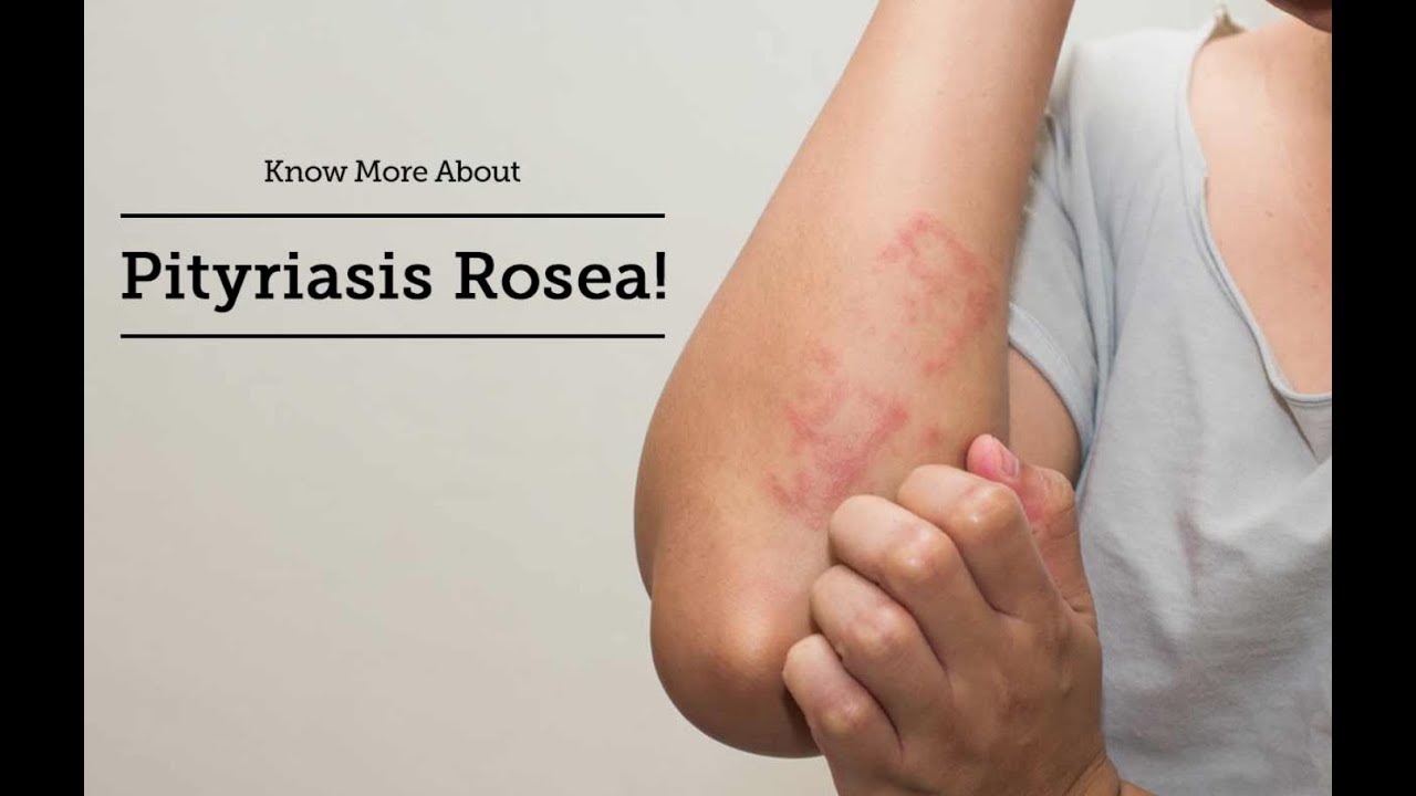 Pityriasis Rosea Youtube