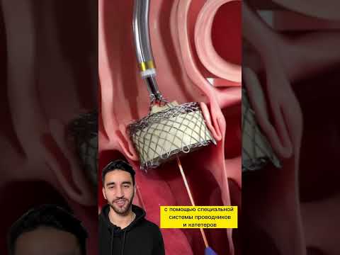 имплантация аортального клапана