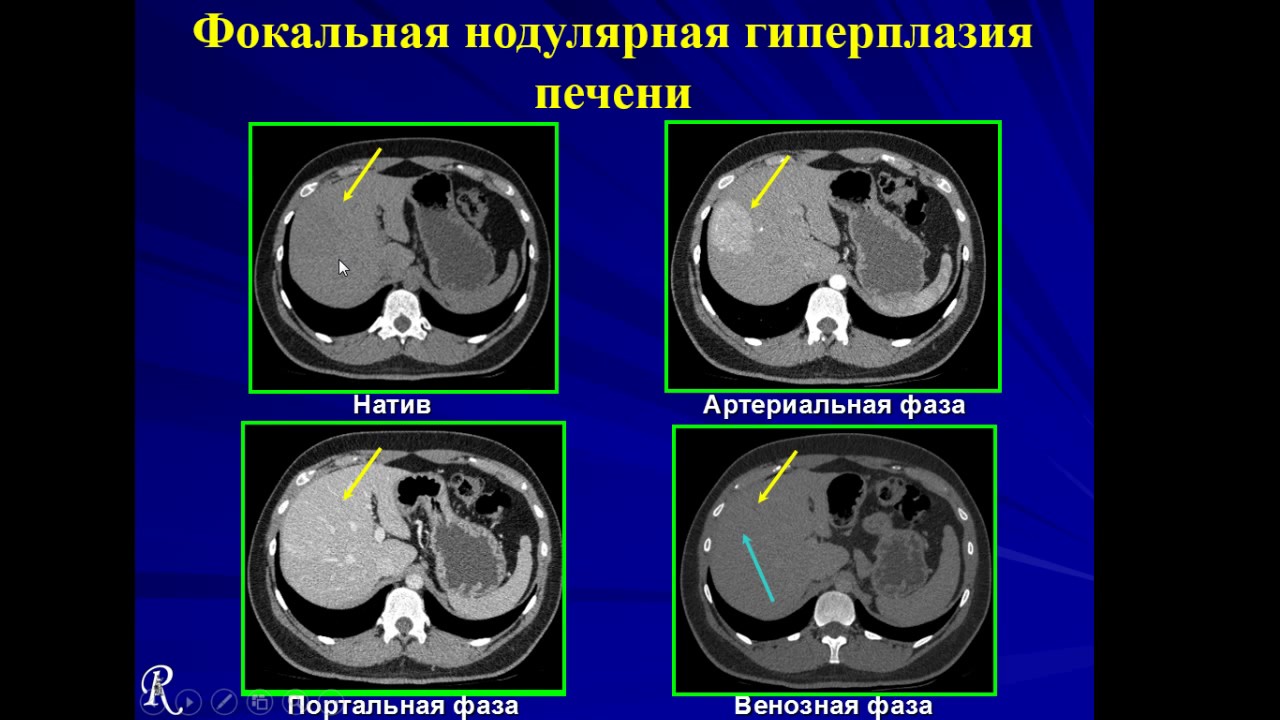 Узловая гиперплазия печени