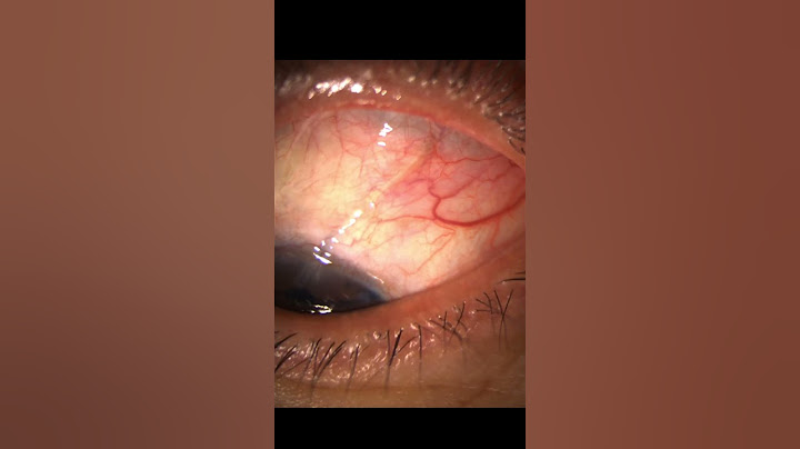Glaucoma Surgery:  Ahmed Valve