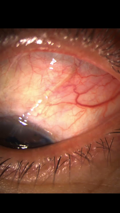 Glaucoma Surgery:  Ahmed Valve