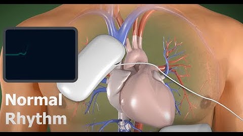 Learn how an AED works - 3D Animation