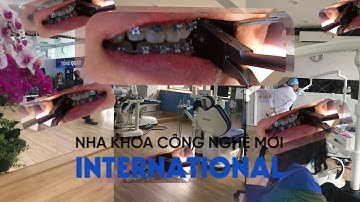 Răng Lệch Lạc🦷Đừng Lo! Sở Hữu Nụ Cười Đều Đặn, Chuẩn "Tỷ Lệ Vàng" Cùng Nha Khoa Công Nghệ Mới! 💎