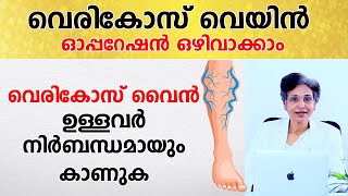 വെരികോസ് വൈൻ ഉള്ളവർ നിർബന്ധമായും കാണുക | Varicose Vein - Avoid Surgery | Arogyam