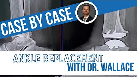 Orthopedic Doctor Explains Ankle Replacement