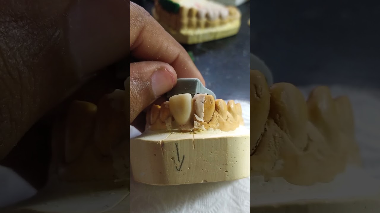 Technique rapide pour couronne provisoire prothèse dentaire