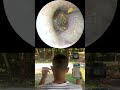 #earwax #earwaxremoval #removal #wax