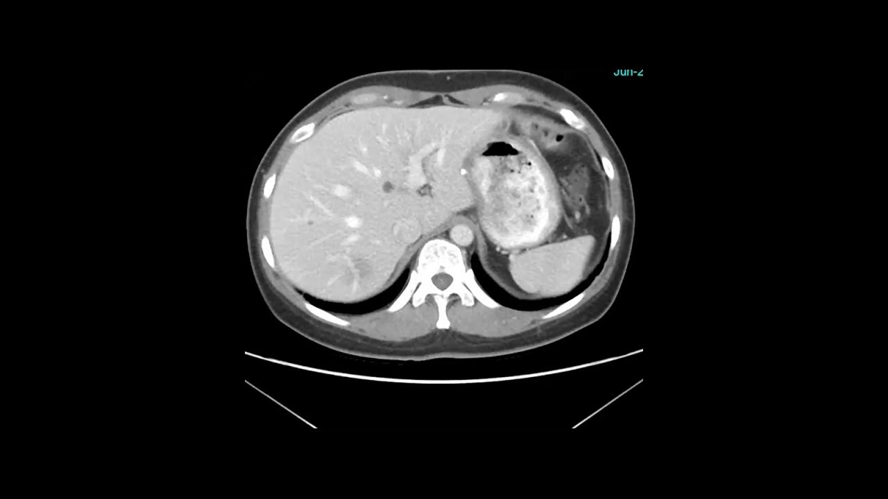 Abdominal Case Conference 1/10/2023 YouTube