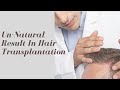 Ghair qudrati natija baloon k transplant k bd Un-Natural Result In Hair Transplantation | Urdu | DMH
