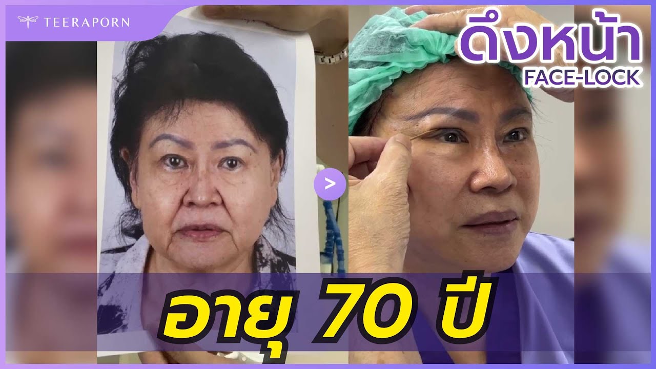 เคยศัลยกรรมตาและจมูกมาแล้วสมัยหมอชลธิศอยู่ศิริราช วันนี้ดึงหน้า FACE-LOCK ครบ 1 วัน พร้อมทำตาเลย