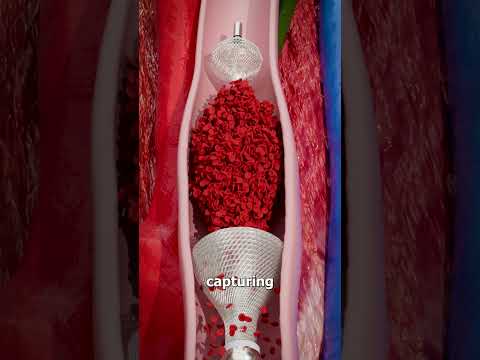 Removing Blood Clots With Vacuum