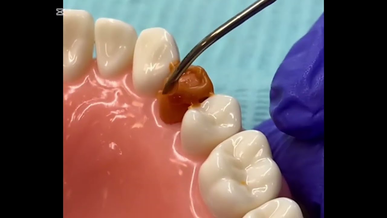 wax up maxillary left first premolar 🩵