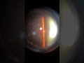 Optic disc(CDR) #eyes #eyehospital #eyevision #optometry #opthalmology #opthalmologist #eyevision