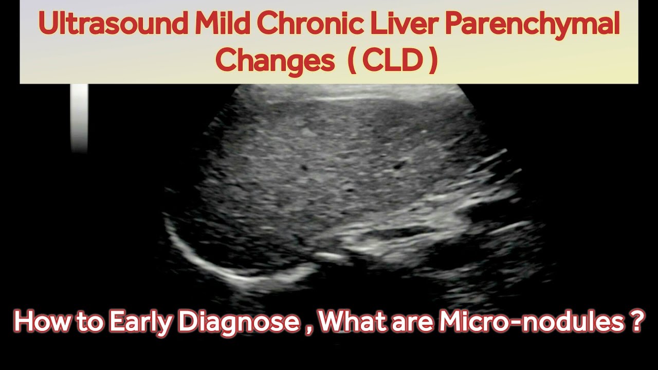 Ultrasound Diagnosis Of Mild Chronic Liver Parenchymal Changes CLD Ultrasound Diagnosis Of Mild Chronic Liver Parenchymal Changes CLD