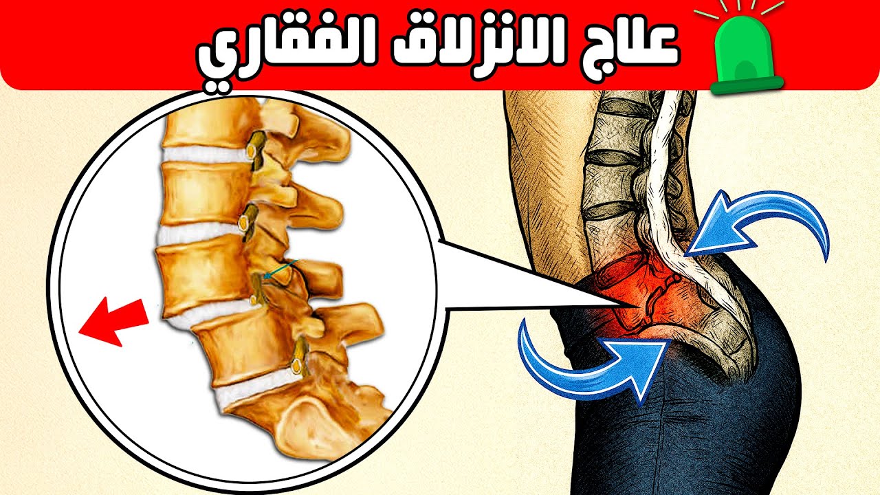 علاج الإنزلاق الفقاري كسر فقاري || علاج الم الظهر مع الانحناء يصاحبه وخز وخدر أو ضعف في الاقدام