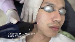 Advanced Eco2 Fractional Laser Treatment