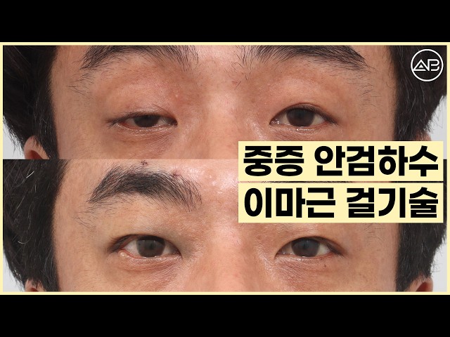 눈매교정으로 못 고치는 중증 안검하수 해결방법 | 에이비성형외과
