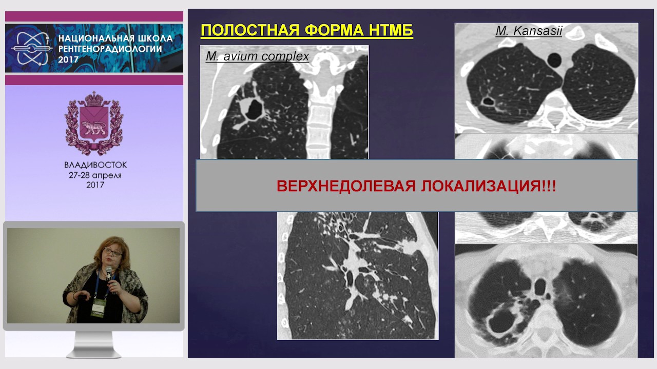 Нетуберкулезный микобактериоз. Микобактериоз легких на кт. Микобактериоз легких СКТ. Нетуберкулезный микобактериоз легких кт. Диссеминированный микобактериоз легких.