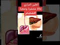 الطين المراري 