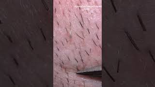 Beard Hair Removal and Beard Pluking 18 #beard #hair #plucking