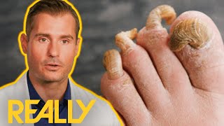 Patient With Bad Toenail Fungus WAKES UP During His Operation l My Feet Are Killing Me