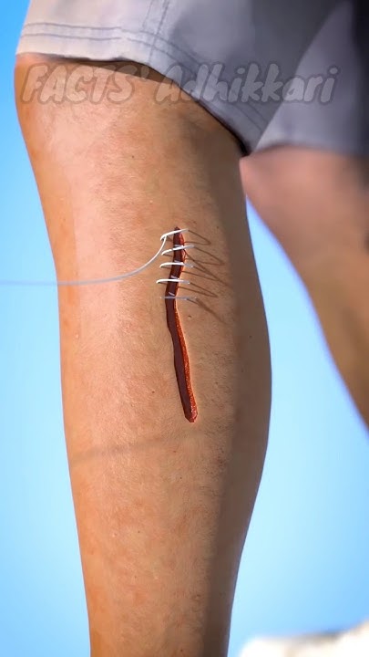 why-do-doctors-put-stitches-on-injuries-facts-shorts-youtube