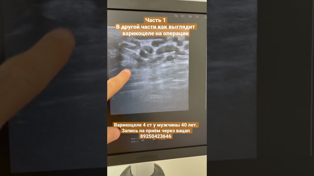 Варикоцеле 4 ст. у мужчины. Часть 1. Уролог. Флеболог Москва - YouTube