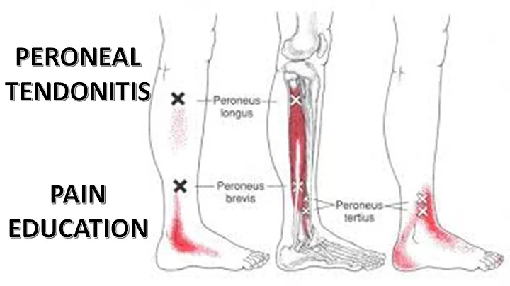 PERONEAL TENDONITIS | MY OWN PAIN MANAGEMENT | TUA...