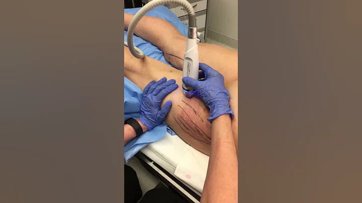 EndyMed Intensif Treatment for Skin Tightening in ...