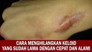 Cara Menghilangkan Keloid yang Sudah Lama dengan Cepat dan Alami