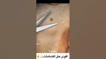 طريقة إزالة الشامات بالخيط Shorts 