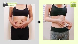 รีวิวศัลยกรรม) ปั้นเอวเอส โดยหมอฮง screenshot 2