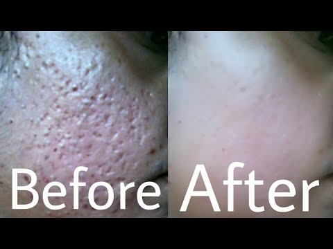 Cinnamon Powder and honey For Acne Scars| dalchini for pimples