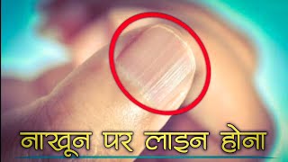 Nakhun Par Line Hona | Nakhun Par Lakeer Hona |  Nakhun Par Kali Line Hona | Matlab Lines On Nails