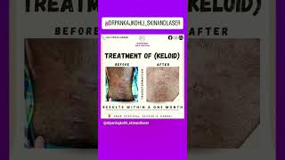 Treatment of Keloid #keloidtreatment keloid #skinclinic #haircaretips #nailcare