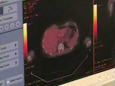 Videó: A PET / CT Képek Deformálható és Merev Regisztrációja A Fej-, Nyaki- és Tüdőrákos Betegek Sugárterápiás Tervezéséhez: Egy Retrospektív Dosimetrikus összehasonlítás