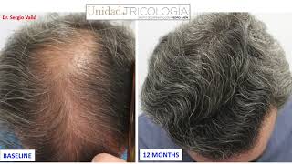 Trasplante capilar técnica FUE 4200 unidades foliculares (frontal, midscalp y coronilla).